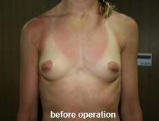 plastic-surgery-breast-augmentation 